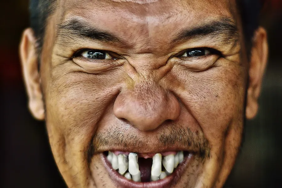 Adult smile with visible missing front teeth for veneer suitability discussion in China - QGO Medical