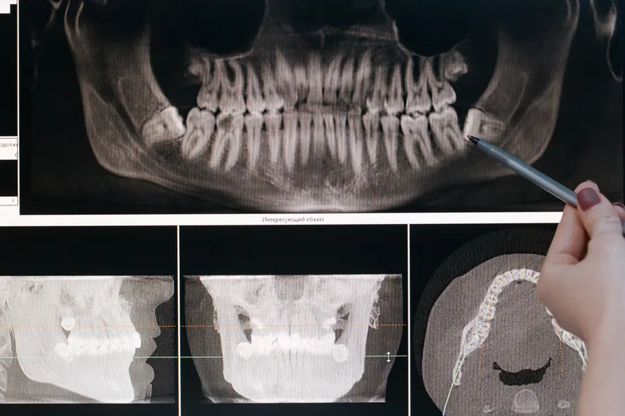 Dental X-ray screen used for all-on-4 implant planning in China - QGO Medical