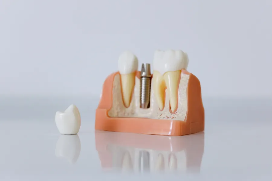 Dental implant model used to explain same day implant risks in China - QGO Medical