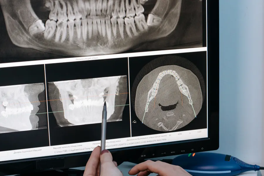 Dentist reviewing jawbone X-ray for same day implant planning in China - QGO Medical