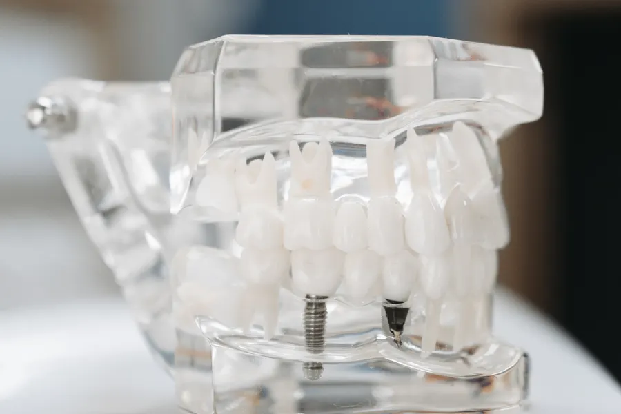 Transparent dental implant model used to compare veneers bridges and implants in China - QGO Medical